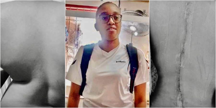 Laurencia Receives Life-Changing Surgery in Richmond Through World Pediatric Project woman who underwent scoliosis repair surgery